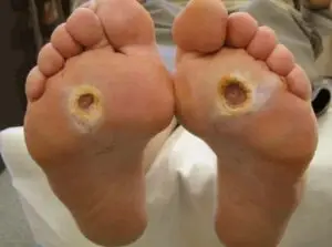 Diabetic Foot